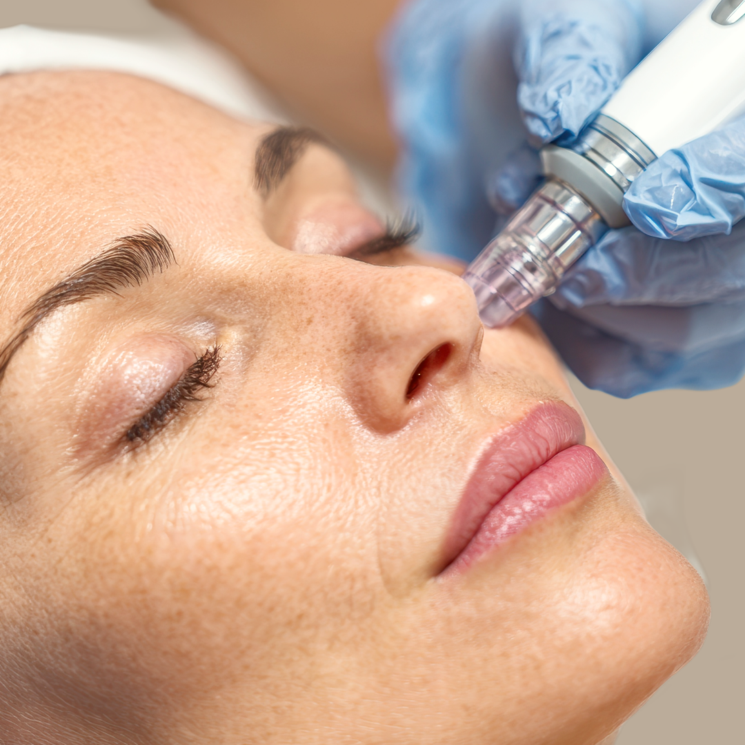 Photo of RF microneedling procedure